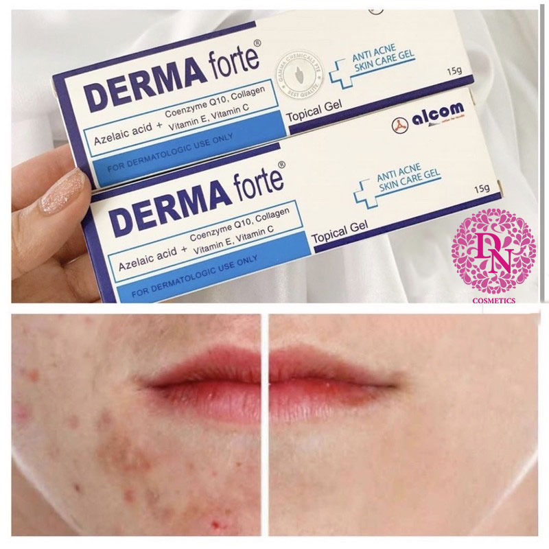 kem-tri-tham-mun-derma-forte-15g